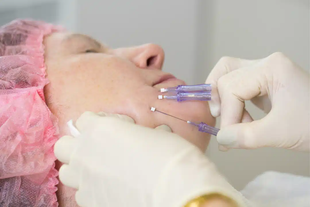 A cosmetic procedure using a device on a woman's cheek.